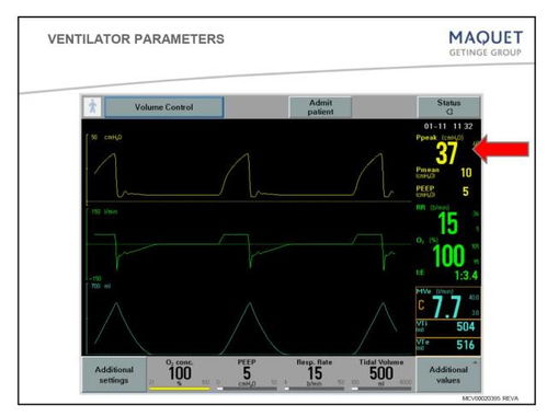 送給臨床小白 呼吸機模式及參數設置圖文詳解