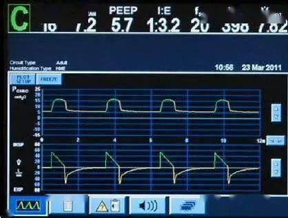 ICU必備工具 呼吸機ST模式的專業解讀與臨床應用