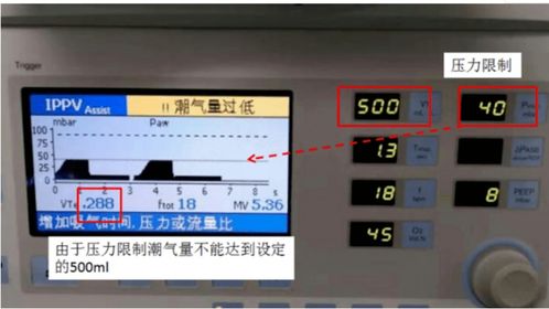 呼吸機5種模式不會選擇？看完這篇你就懂了——ST模式詳解